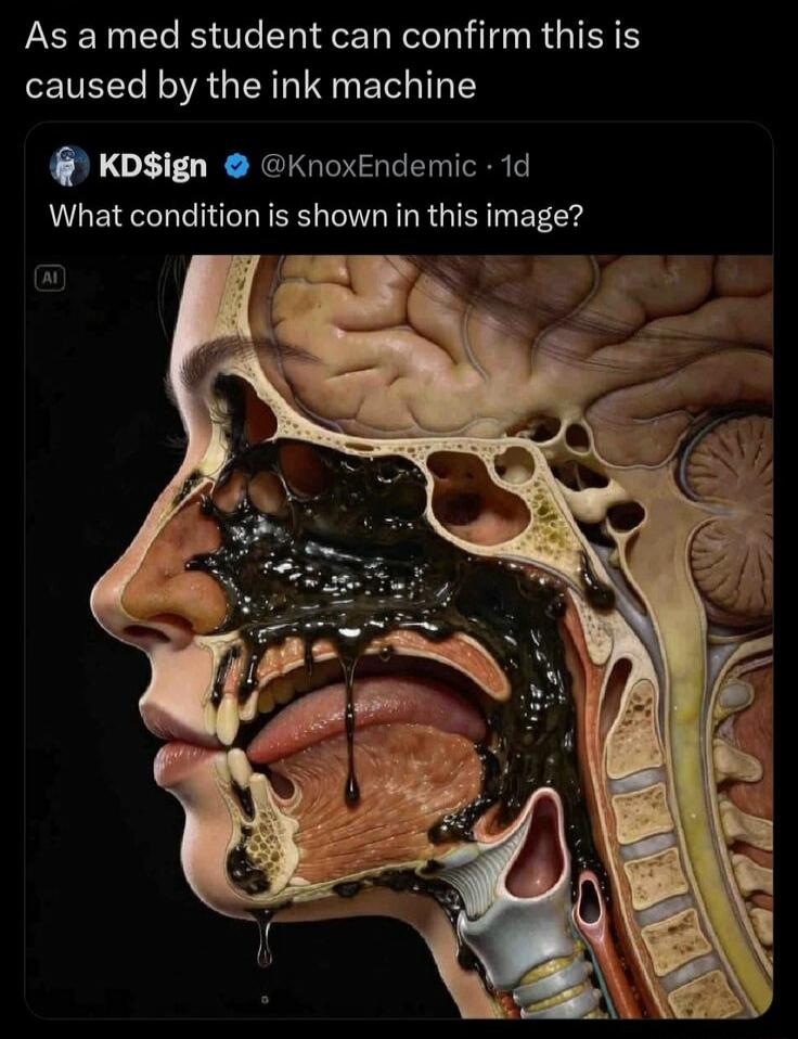 As a med student can confirm this is caused by the ink machine
What condition is shown in this image?