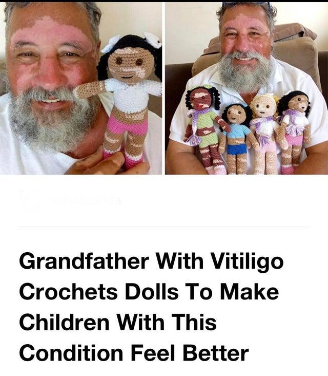 Grandfather With Vitiligo Crochets Dolls To Make Children With This Condition Feel Better
