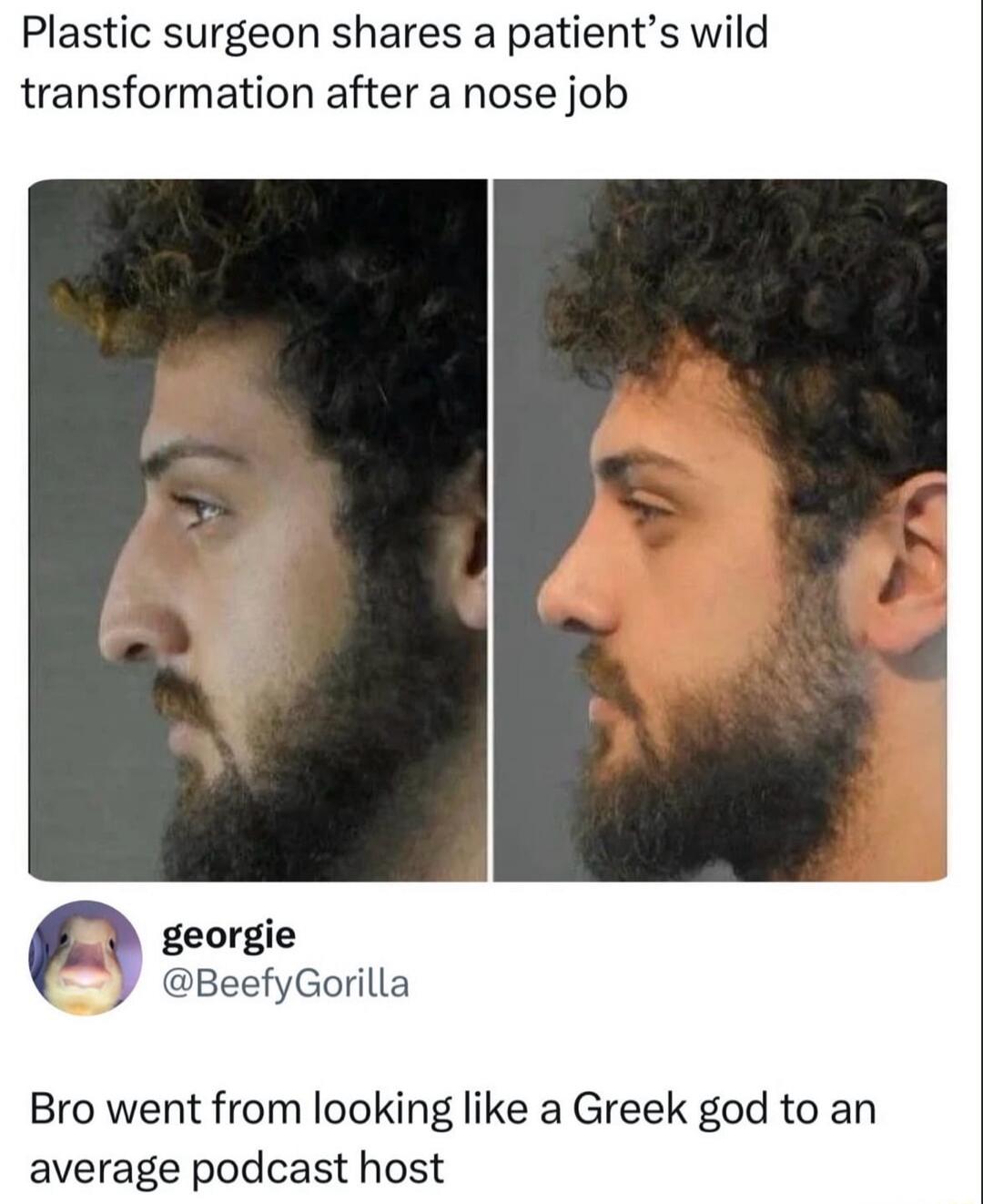 Plastic surgeon shares a patient's wild transformation after a nose job. Bro went from looking like a Greek god to an average podcast host.