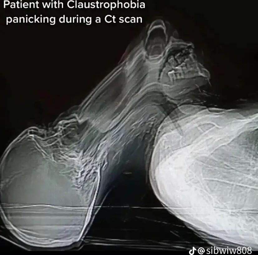 LGSRV QRO TS o elple o panicking during a Ct scan