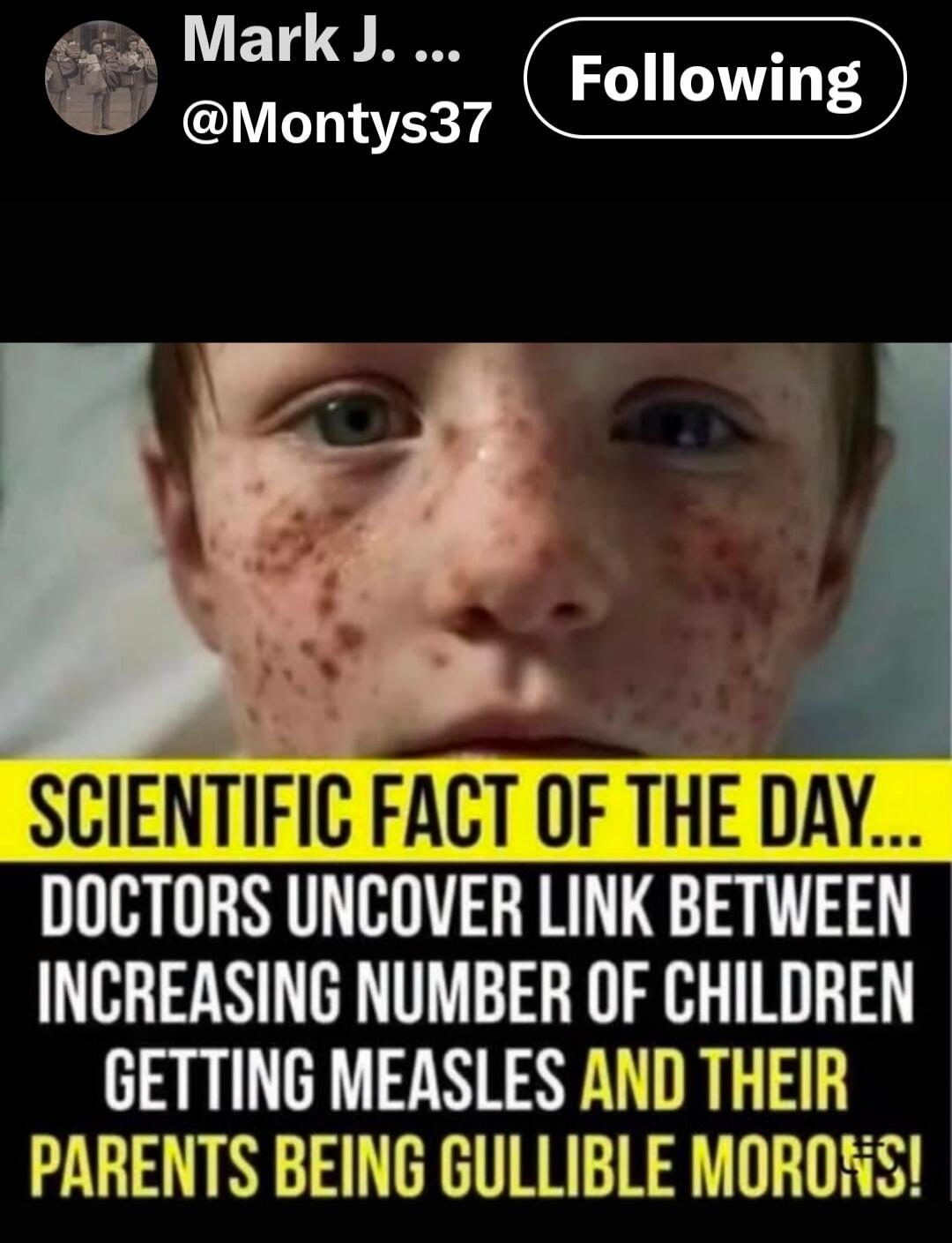 SCIENTIFIC FACT OF THE DAY... DOCTORS UNCOVER LINK BETWEEN INCREASING NUMBER OF CHILDREN GETTING MEASLES AND THEIR PARENTS BEING GULLIBLE MORONS!