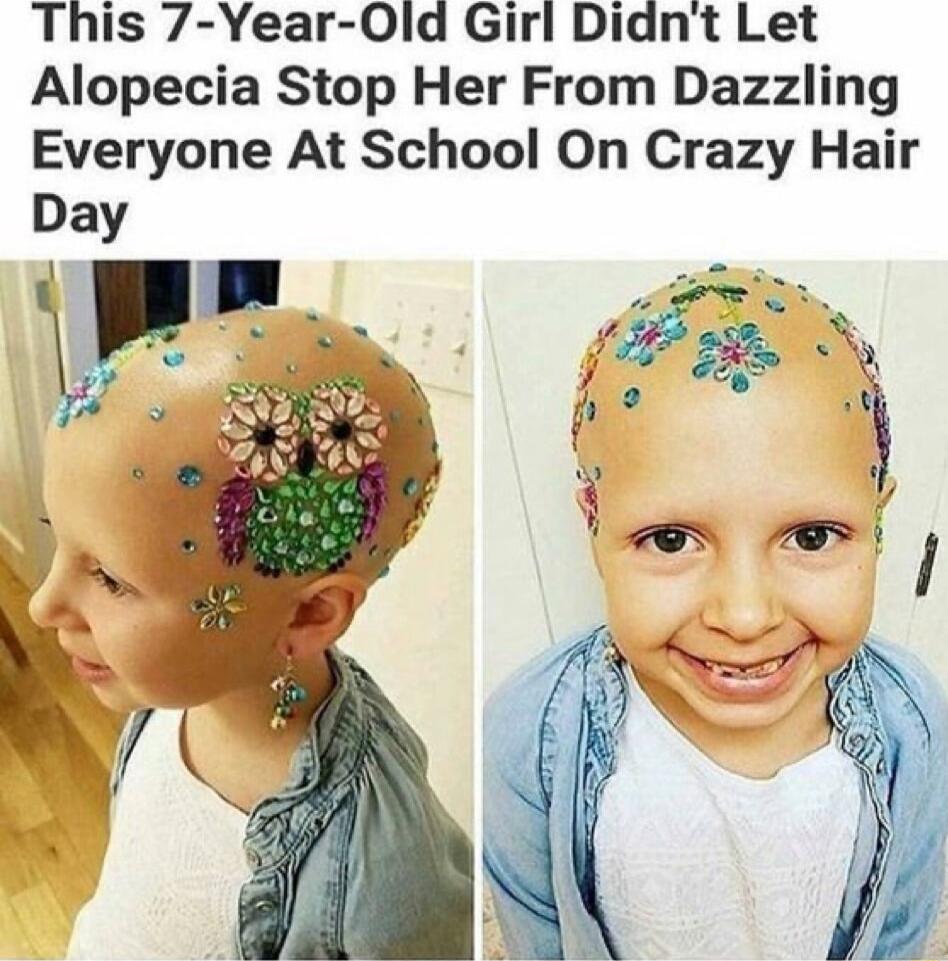 This 7 Year 0ld Girl Didnt Let Alopecia Stop Her From Dazzling Everyone At School On Crazy Hair