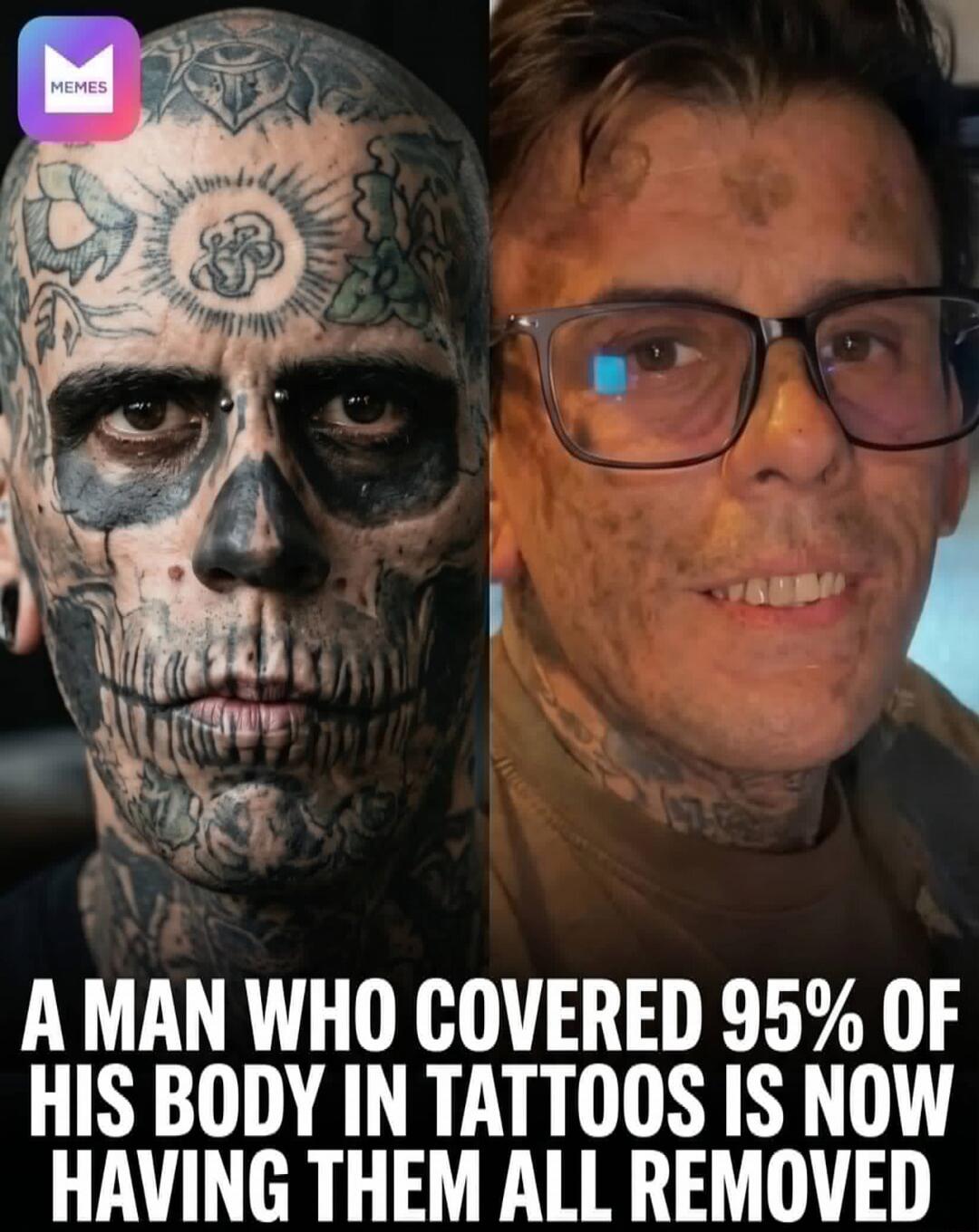 A MAN WHO COVERED 95% OF HIS BODY IN TATTOOS IS NOW HAVING THEM ALL REMOVED