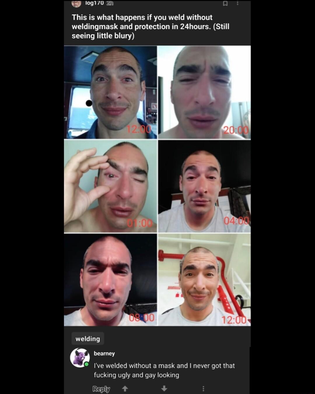 o Lo This is what happens if you weld without weldingmask and protection in 24hours Still seeing it blury welding beamer e welded without mask and never got that fucking ugly and gay looking aply