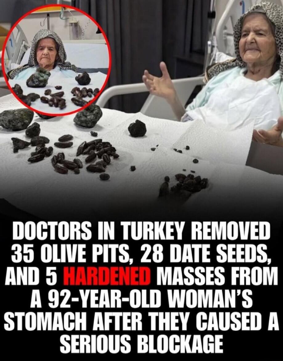 DOCTORS IN TURKEY REMOVED 35 OLIVE PITS, 28 DATE SEEDS, AND 5 HARDENED MASSES FROM A 92-YEAR-OLD WOMAN'S STOMACH AFTER THEY CAUSED A SERIOUS BLOCKAGE