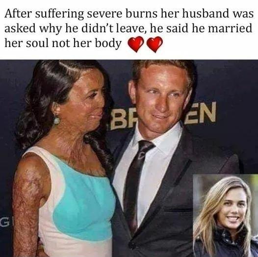 After suffering severe burns her husband was asked why he didnt leave he said he married her soul not her body