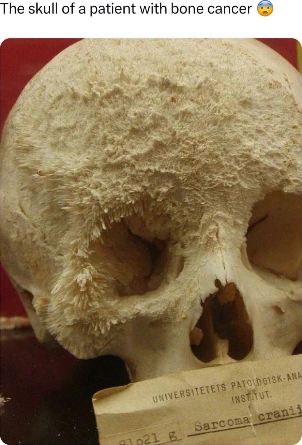 The skull of a patient with bone cancer