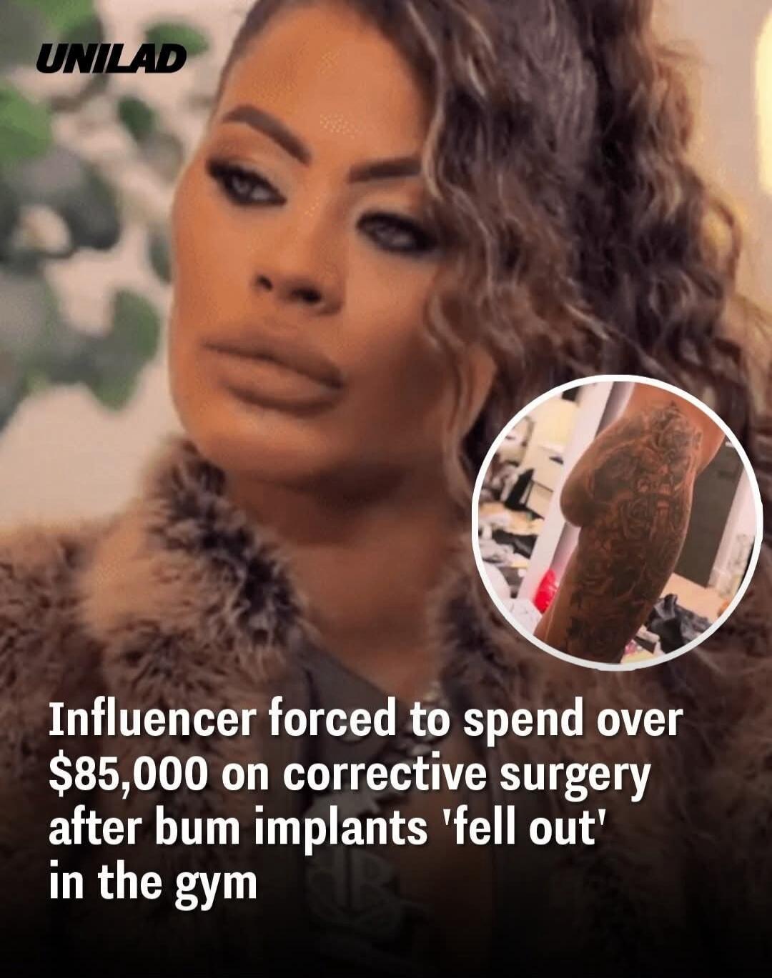 UNILAD
Influencer forced to spend over $85,000 on corrective surgery after bum implants 'fell out' in the gym