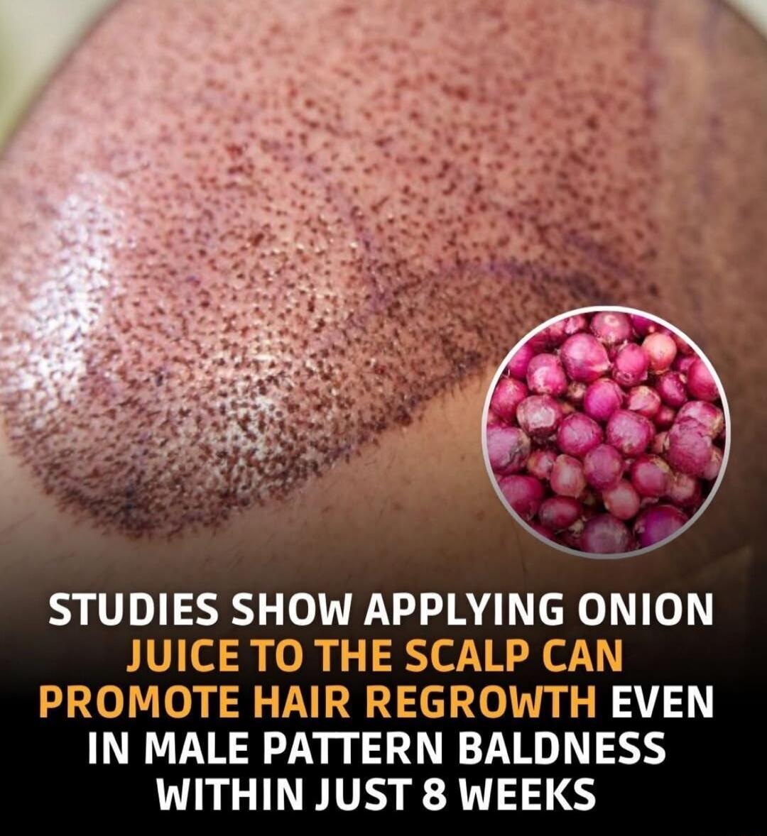 STUDIES SHOW APPLYING ONION JUICE TO THE SCALP CAN PROMOTE HAIR REGROWTH EVEN IN MALE PATTERN BALDNESS WITHIN JUST 8 WEEKS