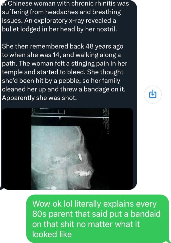 AXSIGEEEAVN ERRVIG RO IC DS G TRIERVER suffering from headaches and breathing issues An exploratory x ray revealed a bullet lodged in her head by her nostril She then remembered back 48 years ago to when she was 14 and walking along a path The woman felt a stinging pain in her temple and started to bleed She thought shed been hit by a pebble so her family EEEL LR EAT N R GIEIEL T EECE L LYTETERIGE