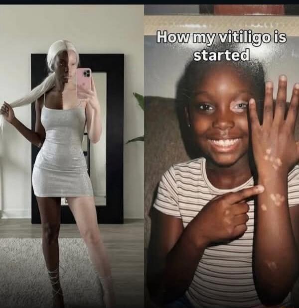 How my vitiligo is started