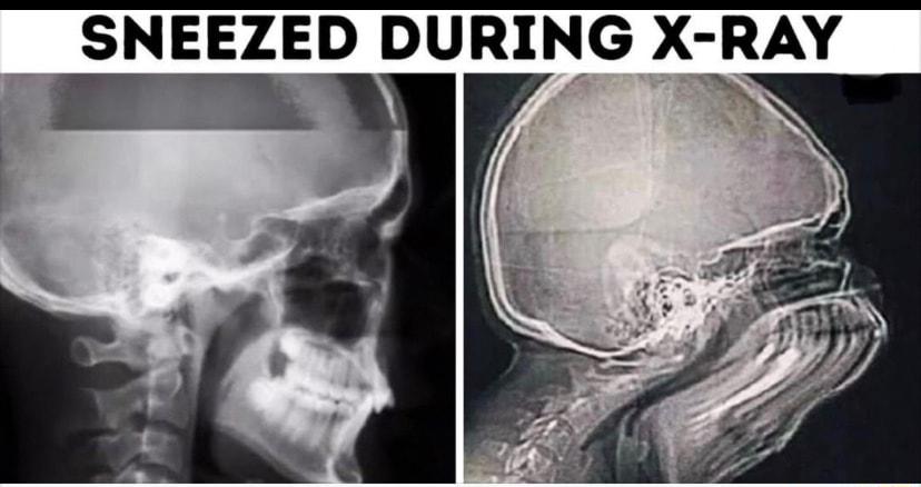 SNEEZED DURING X RAY e Y