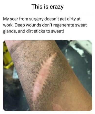 This is crazy My scar from surgery doesnt get dirty at work Deep wounds dont regenerate sweat glands and dirt sticks to sweat