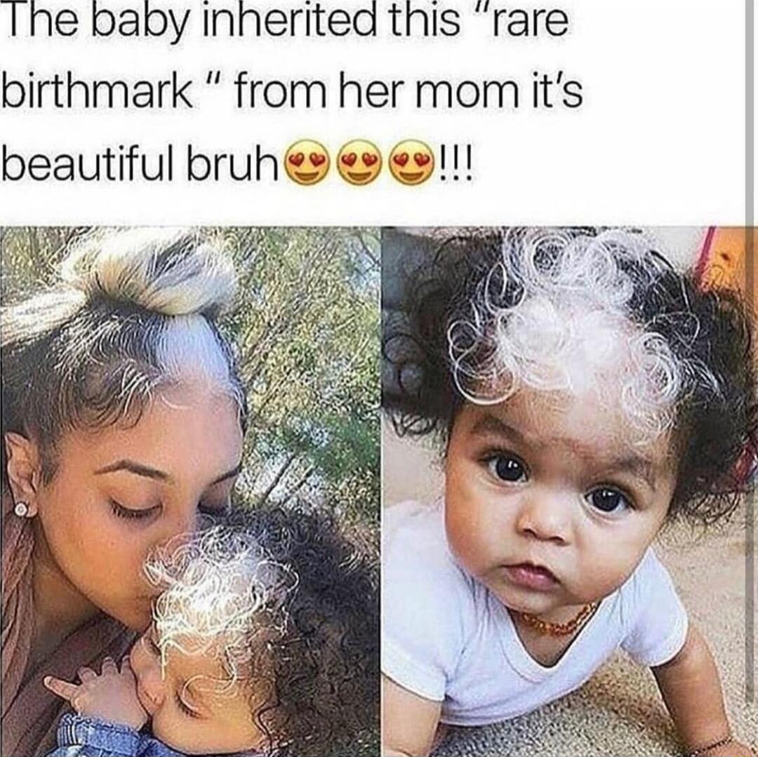 1he baby Inherited this rare birthmark from her momiits beautiful bruhs es