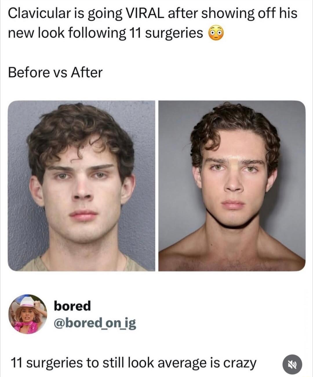 Clavicular is going VIRAL after showing off his new look following 11 surgeries 😳 Before vs After bored @bored_on_ig 11 surgeries to still look average is crazy
