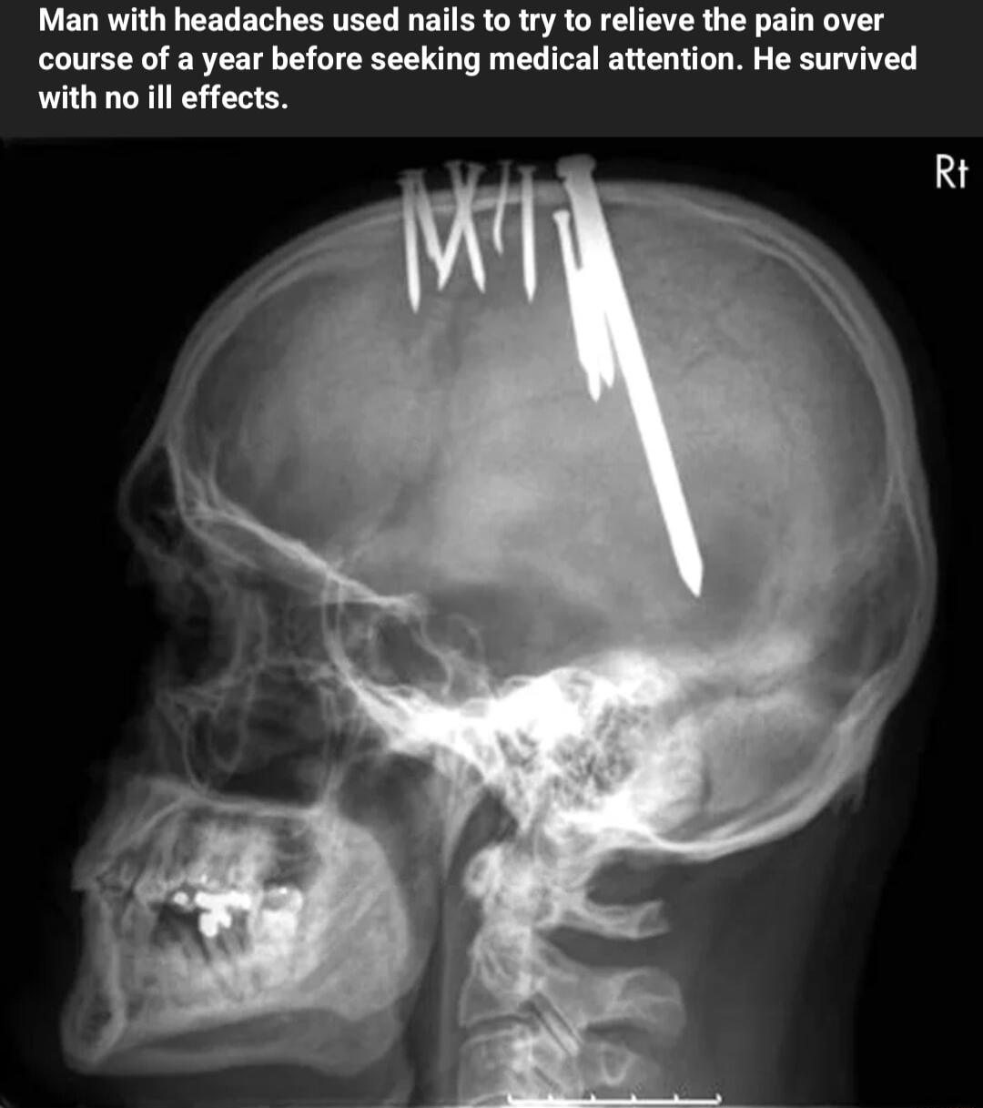 Man with headaches used nails to try to relieve the pain over course of a year before seeking medical attention He survived with no il effects Rt