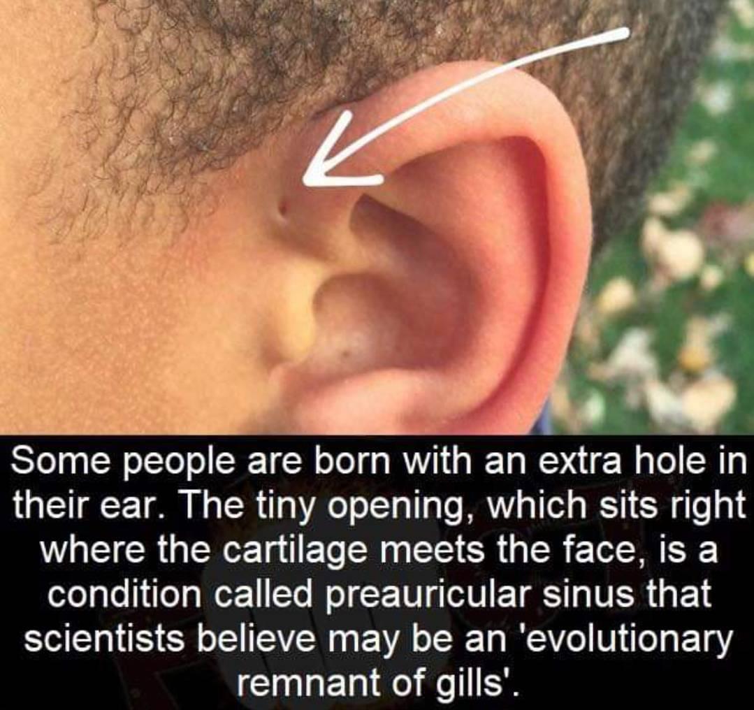 Some people are born with an extra hole in their ear The tiny opening which sits right WL CRUTERE R EL N EE SR R L condition called preauricular sinus that scientists believe may be an evolutionary remnant of gills