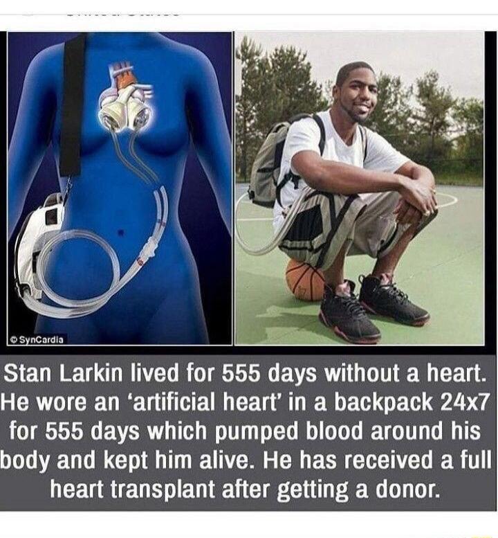 Stan Larkin lived for 555 days without a heart. He wore an 'artificial heart' in a backpack 24x7 for 555 days which pumped blood around his body and kept him alive. He has received a full heart transplant after getting a donor.