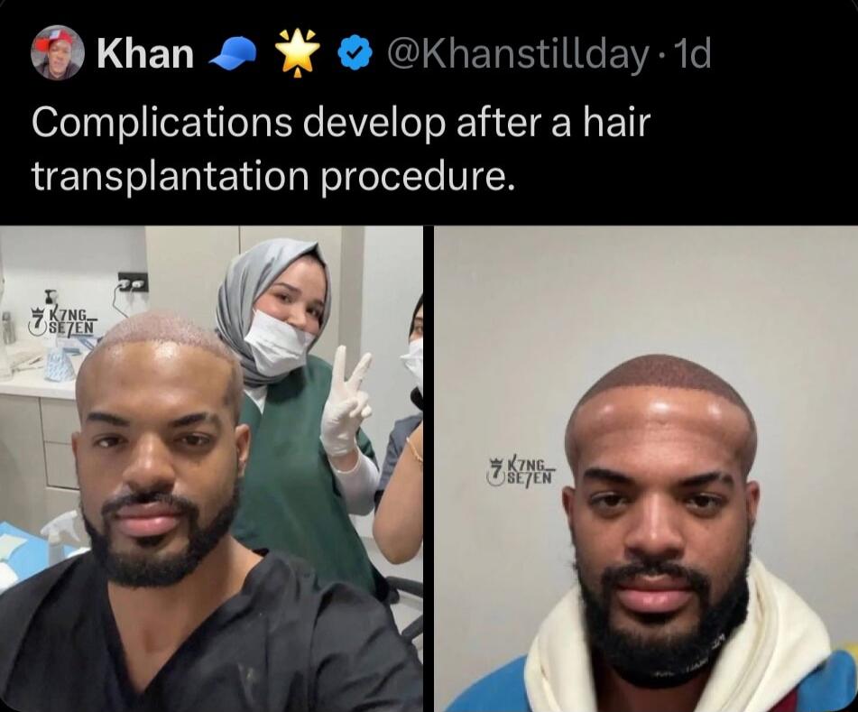 Complications develop after a hair transplantation procedure.