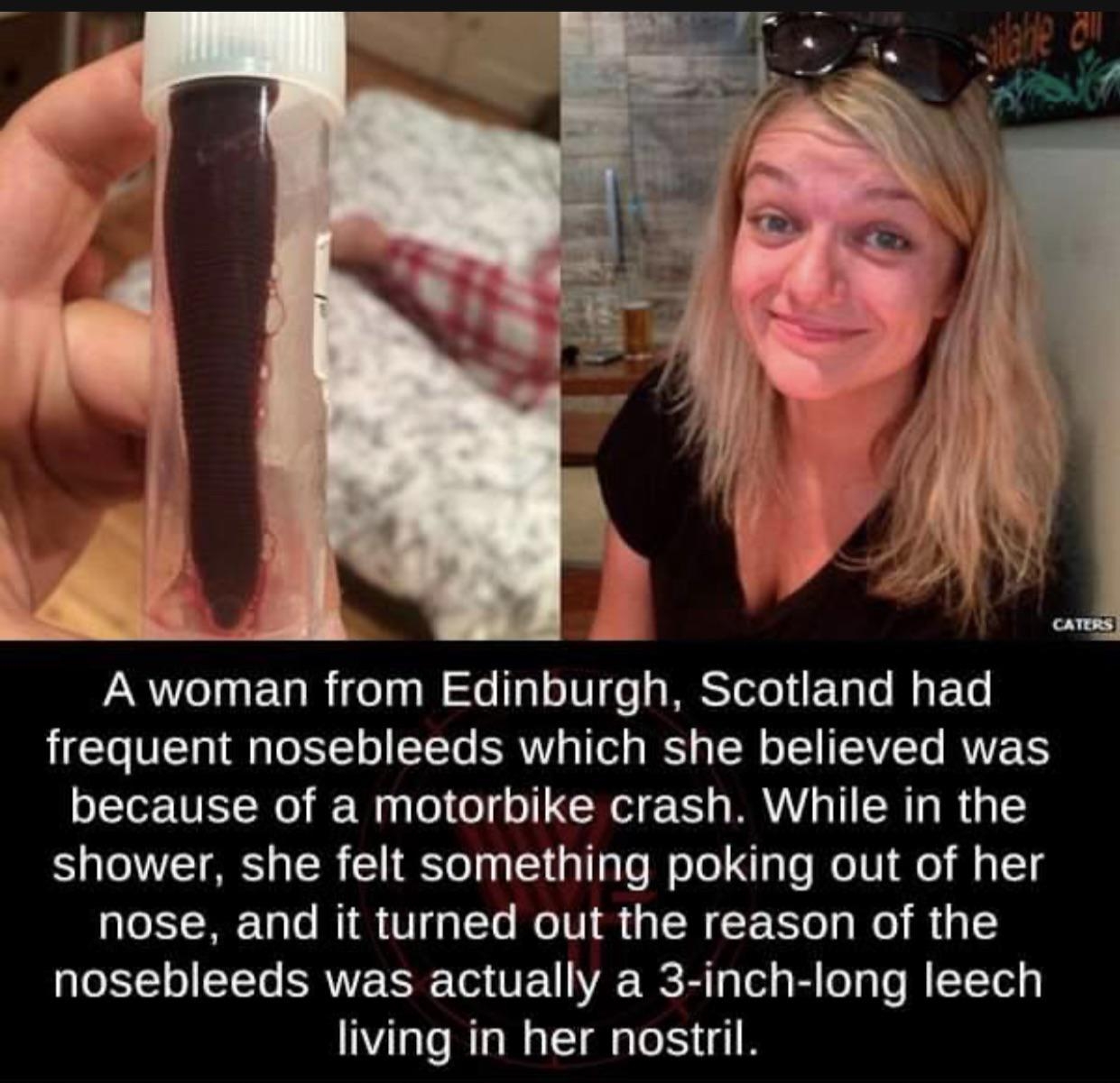 A woman from Edinburgh Scotland had frequent nosebleeds which she believed was because of a motorbike crash While in the shower she felt something poking out of her nose and it turned out the reason of the nosebleeds was actually a 3 inch long leech living in her nostril Photo courtesy of Caters via BBC factsweird