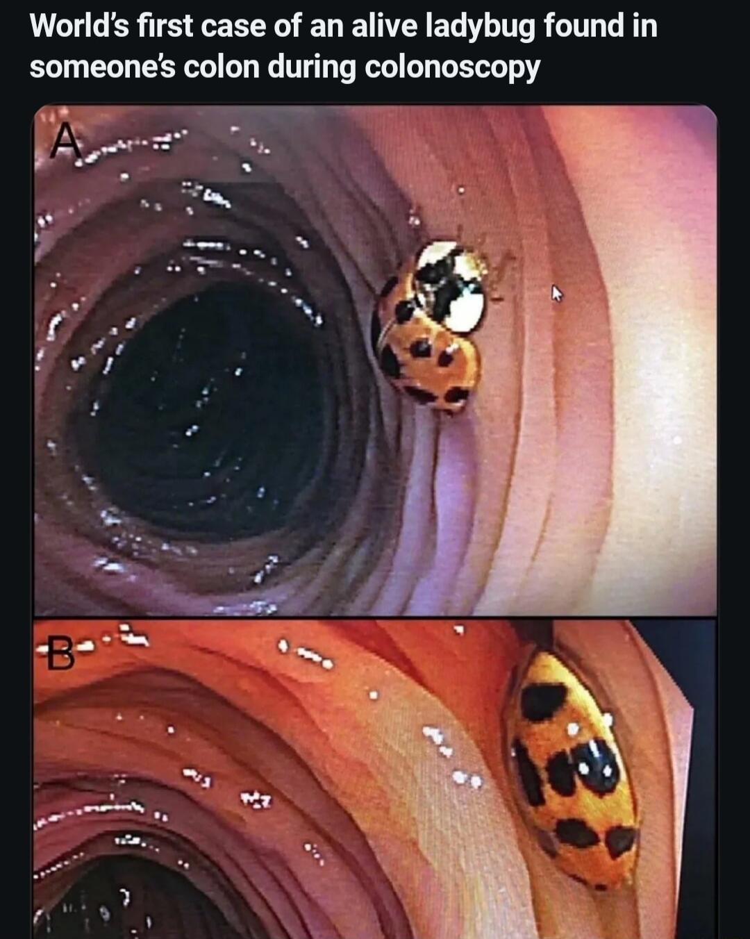 Worlds first case of an alive ladybug found in someones colon during colonoscopy