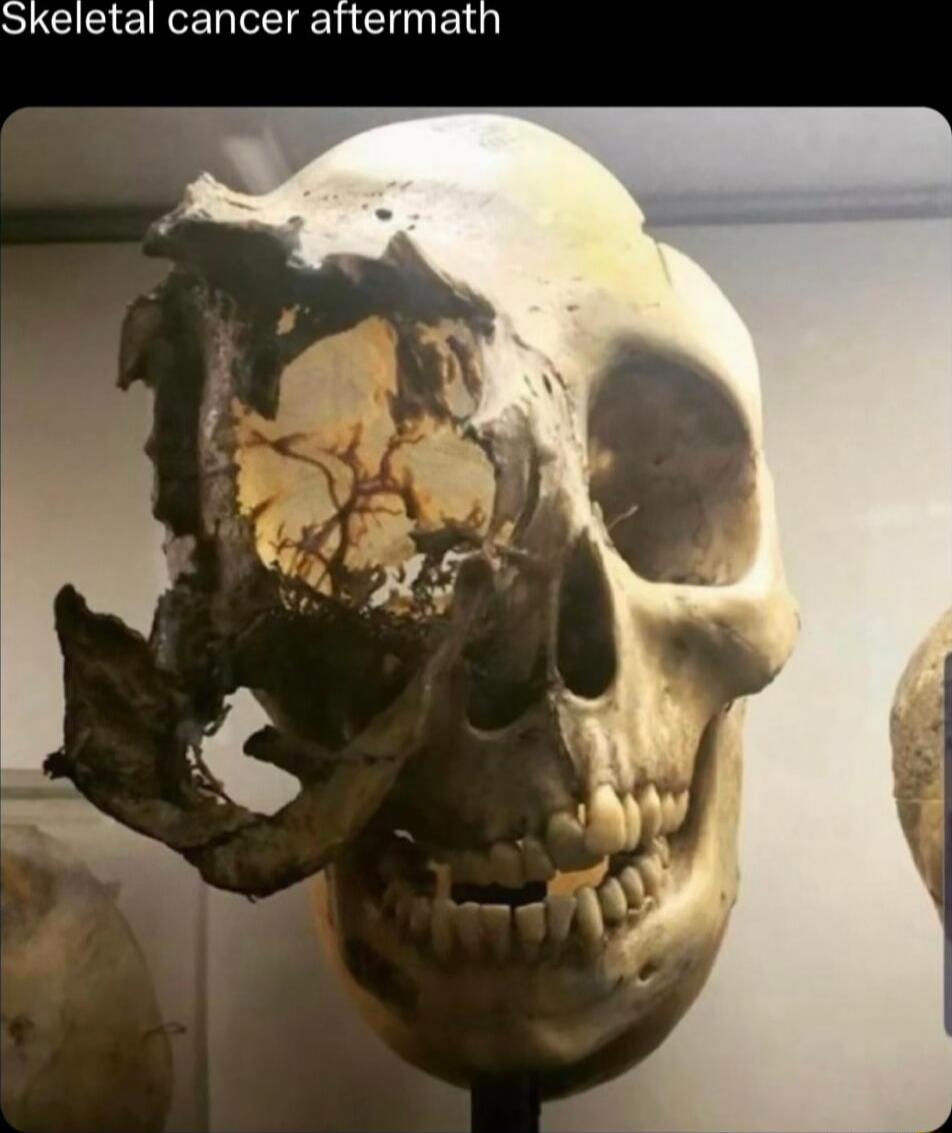 Skeletal cancer attermath