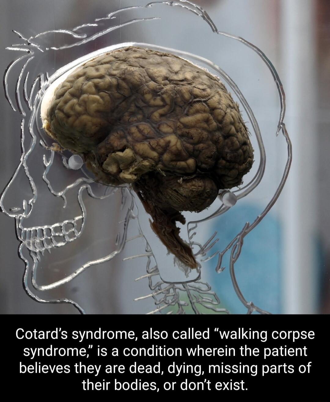 Cotards syndrome also called walking corpse syndrome is a condition wherein the patient believes they are dead dying missing parts of their bodies or dont exist