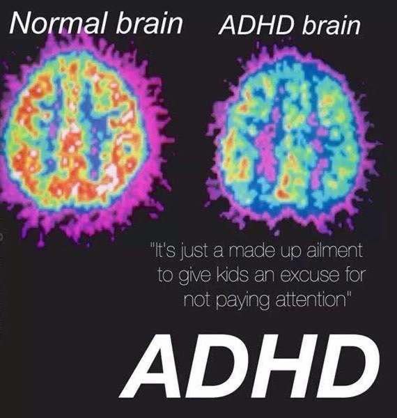 Normal brain ADHD brain Its just made up alment eXe VR o SiE gl 0V chiel not paying attention ADHD