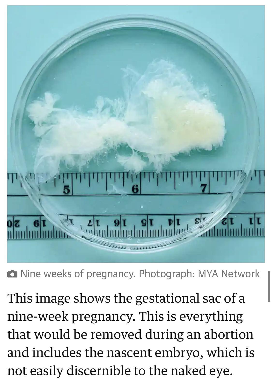 o Nine weeks of pregnancy Photograph MYA Network This image shows the gestational sac of a nine week pregnancy This is everything that would be removed during an abortion and includes the nascent embryo which is not easily discernible to the naked eye