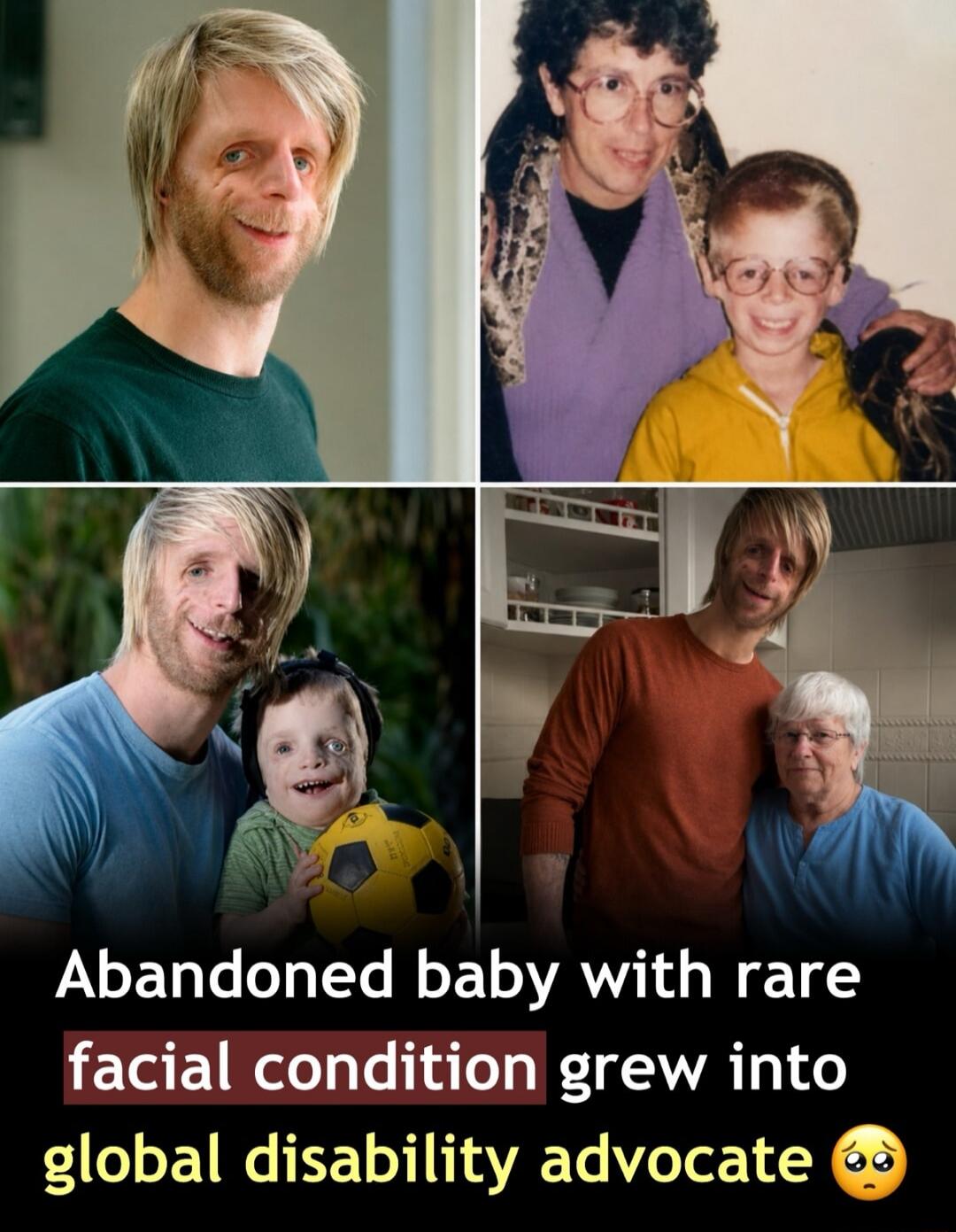 Abandoned baby with rare facial condition grew into global disability advocate