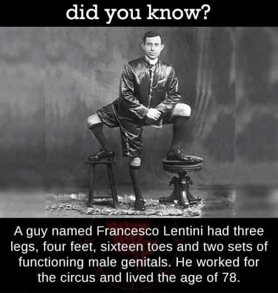 A guy named Francesco Lentini had three legs four feet sixteen toes and two sets of functioning male genitals He worked for LUERVTTERE UL RNV RGER T N iR