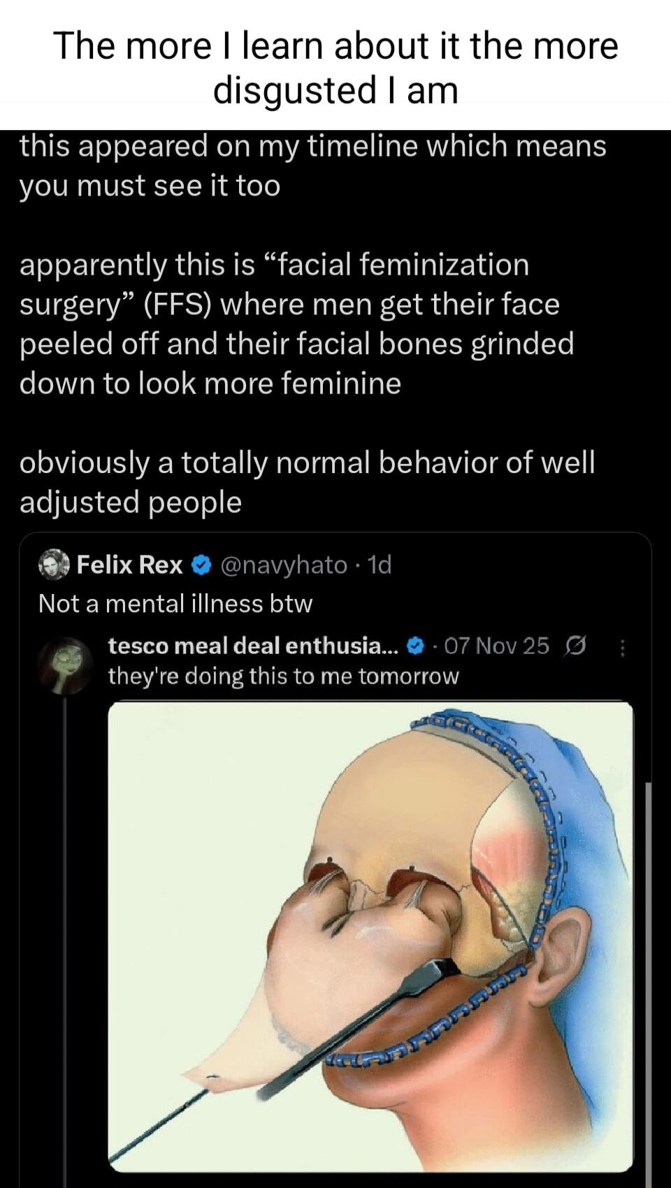 The more I learn about it the more disgusted I am
this appeared on my timeline which means you must see it too
apparently this is “facial feminization surgery” (FFS) where men get their face peeled off and their facial bones grinded down to look more feminine
obviously a totally normal behavior of well adjusted people

Felix Rex @ navyhato 1d
Not a