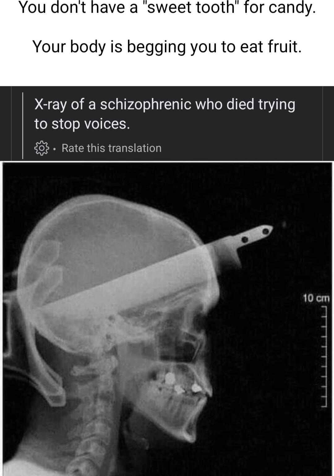 Your body is begging you to eat fruit X ray of a schizophrenic who died trying to stop voices 48 Rate this translation 10 cm