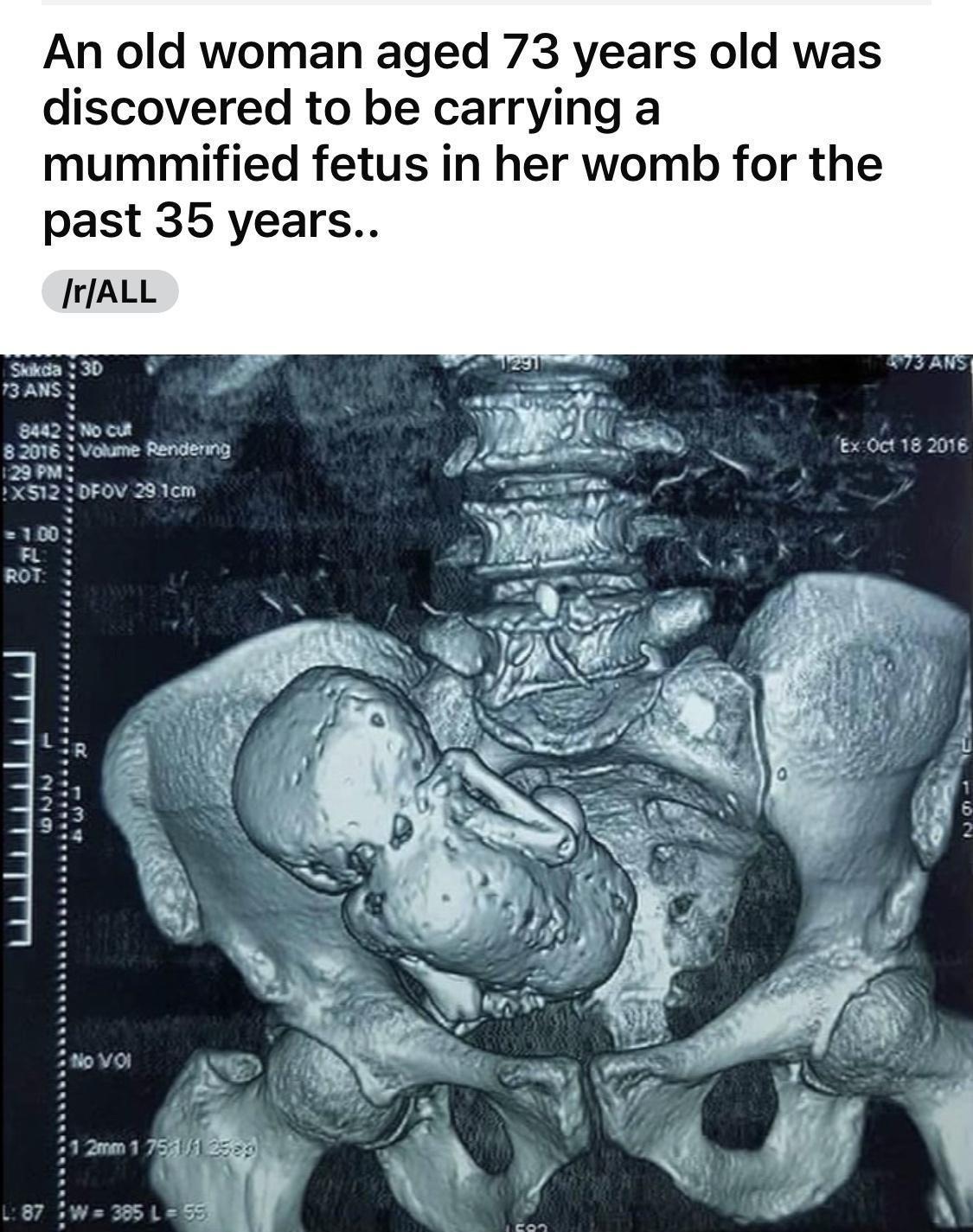 An old woman aged 73 years old was discovered to be carrying a mummified fetus in her womb for the past 35 years JrlALL