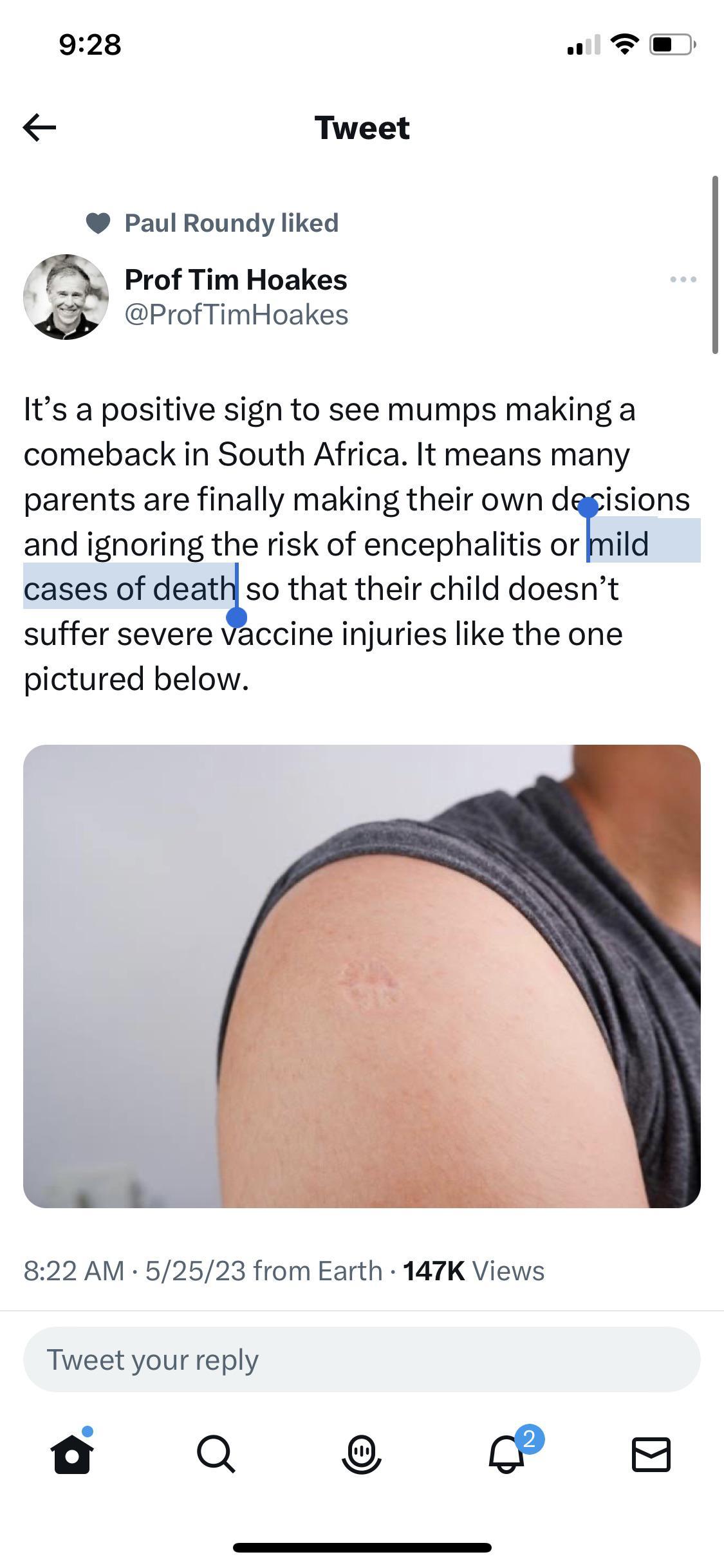 928 Tweet Paul Roundy liked Prof Tim Hoakes ProfTimHoakes Its a positive sign to see mumps making a comeback in South Africa It means many parents are finally making their own dggisions and ignoring the risk of encephalitis omild cases of deatto that their child doesnt suffer severe Vaccine injuries like the one pictured below 822 AM 52523 from Earth 147K Views Tweet your reply a a e