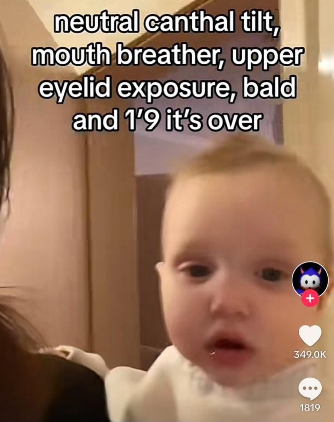 neviE cehiliEidd meythbreather Upper eyelld exposure bald sl