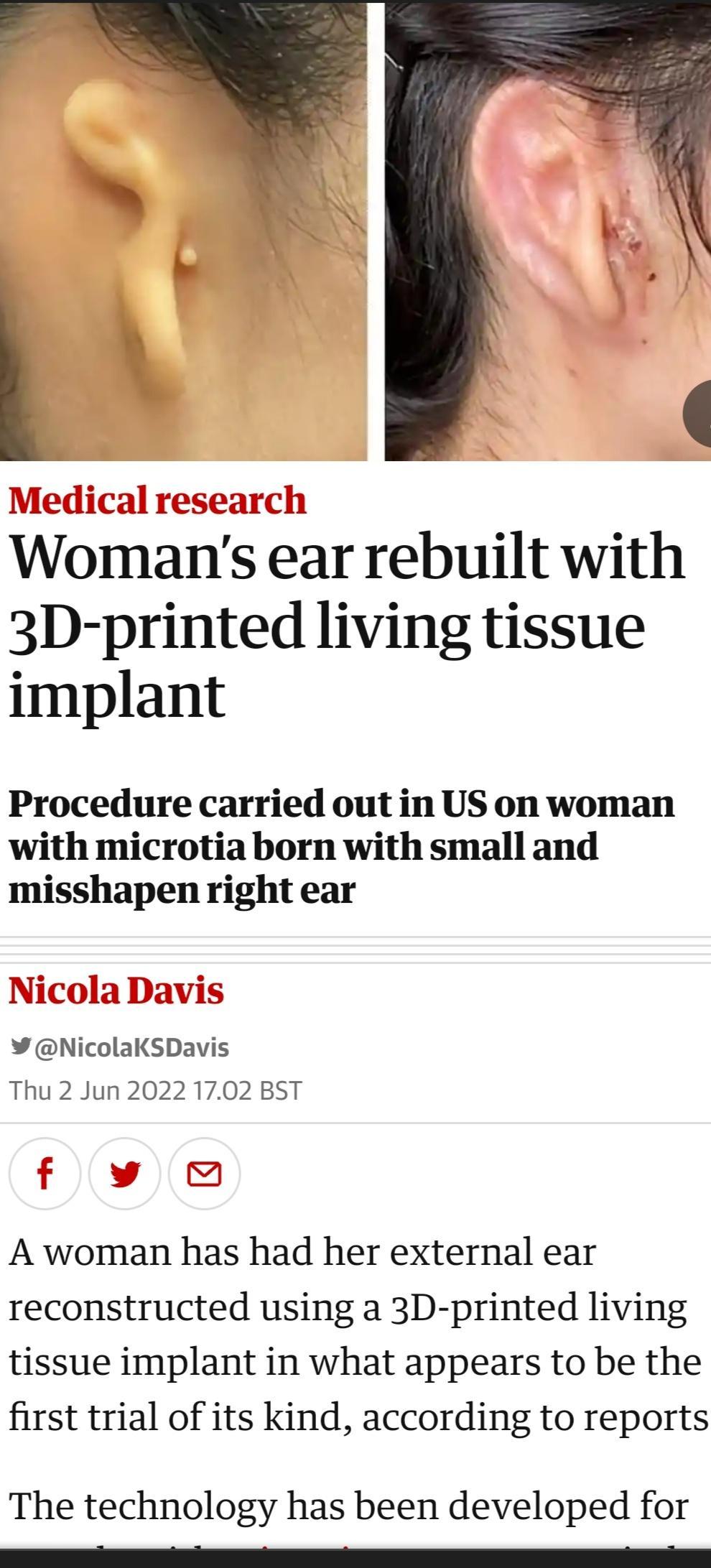 Meq dical ro search IVACTUIC Al 1T Womans ear rebuilt with 3D printed living tissue implant Procedure carried out in US on woman with microtia born with small and misshapen right ear NicolaKSDavis Thu 2 Jun 2022 1702 BST V i A woman has had her external ear reconstructed using a 3D printed living tissue implant in what appears to be the first trial of its kind according to reports The technology h