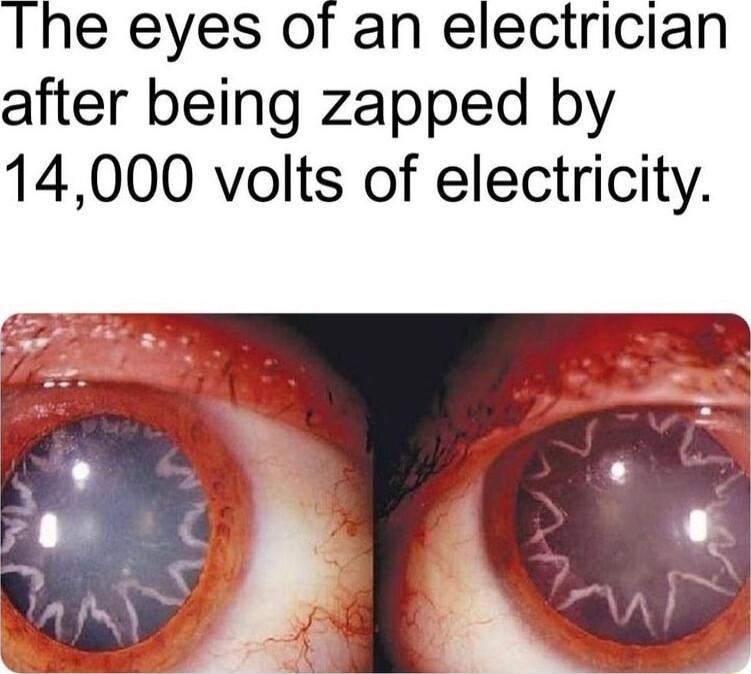 The eyes of an electrician after being zapped by 14000 volts of electricity