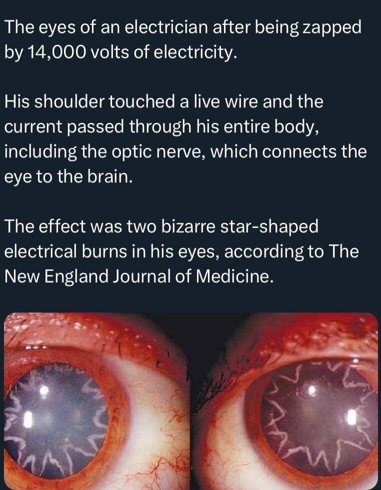The eyes of an electrician after being zapped by 14000 volts of electricity His shoulder touched a live wire and the current passed through his entire body including the optic nerve which connects the EVERCRGELTETN The effect was two bizarre star shaped electrical burns in his eyes according to The New England Journal of Medicine