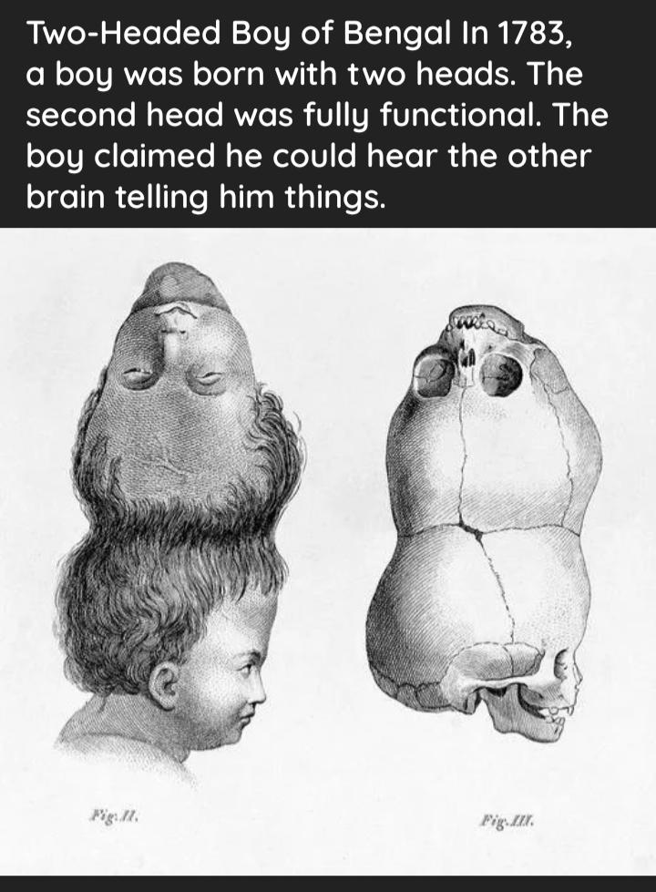 Two Headed Boy of Bengal In 1783 N TeIVRWo I oTeTg g WWT s W A N s T To T S RTeleTy o Ny TTo To RWo R V VIR Vg T3 ileToTo M s boy claimed he could hear the other brain telling him things
